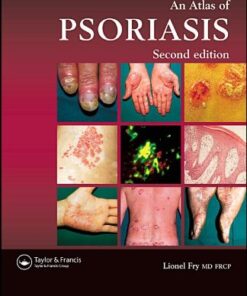 [PDF] An Atlas of Psoriasis, Second Edition Lionel Fry